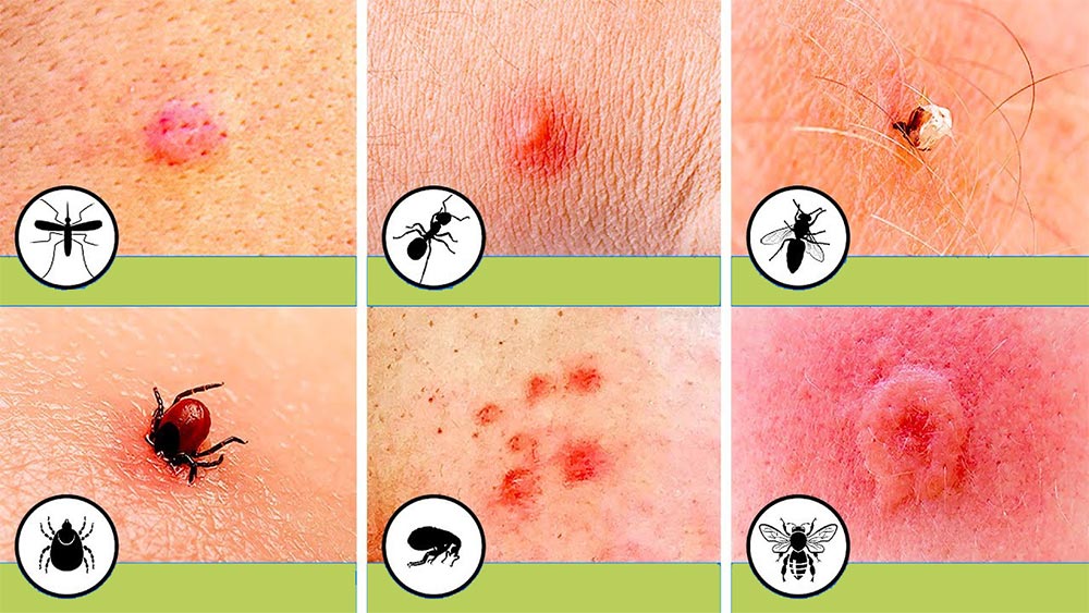 Alergija izazvana ubodom insekta