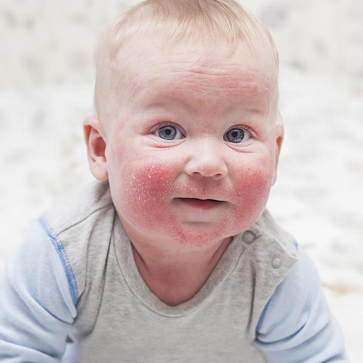 kako zaštiti osetljivu kožu bebe