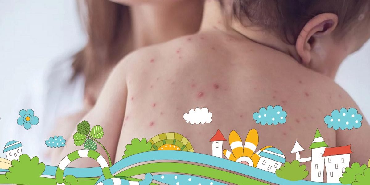 Ovčije boginje ili varičele