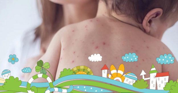 Ovčije boginje ili varičele