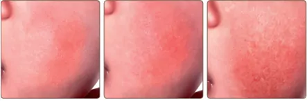 Atopijski dermatitis